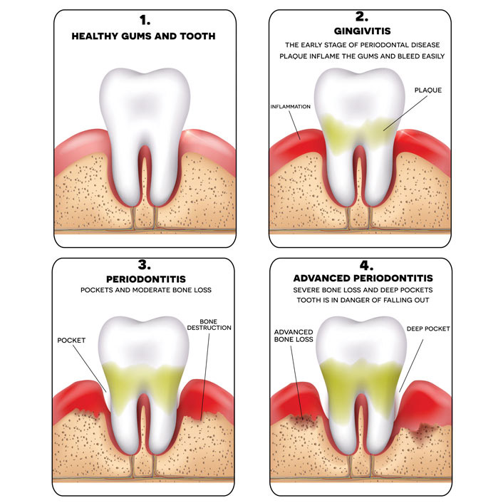 Gum Treatment - Dental Services