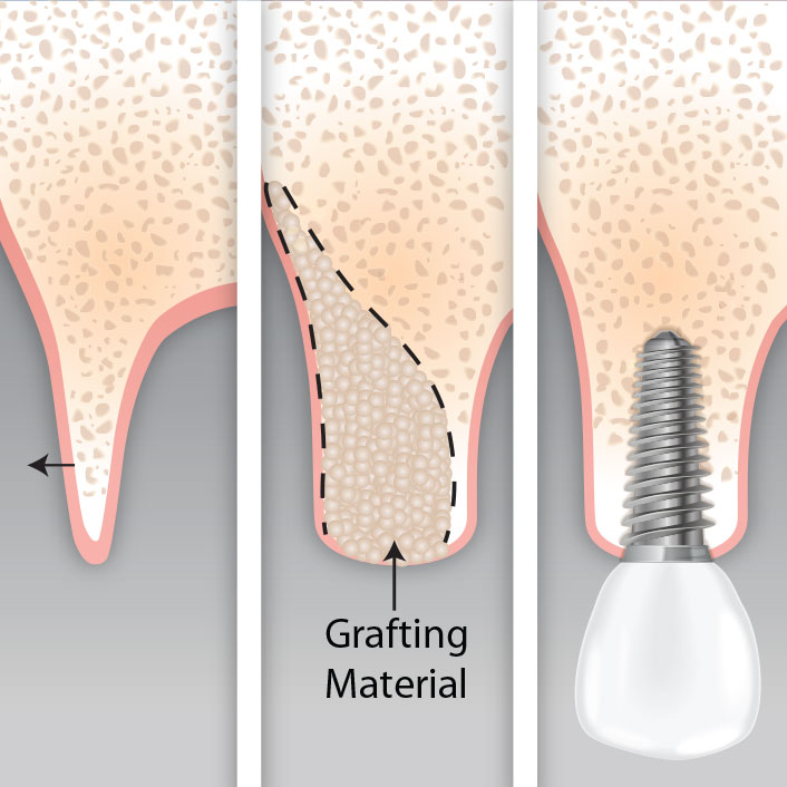 Guided Bone Regeneration - Dental Services