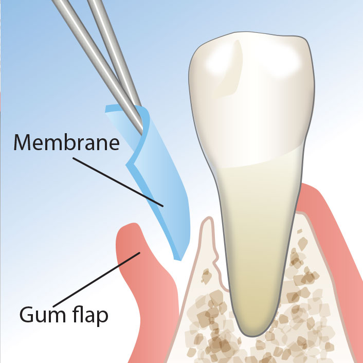 Guided Tissue Regeneration

 - Dental Services