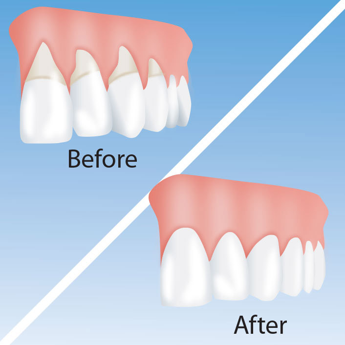 Gum Recession Corrective Surgery - Dental Services