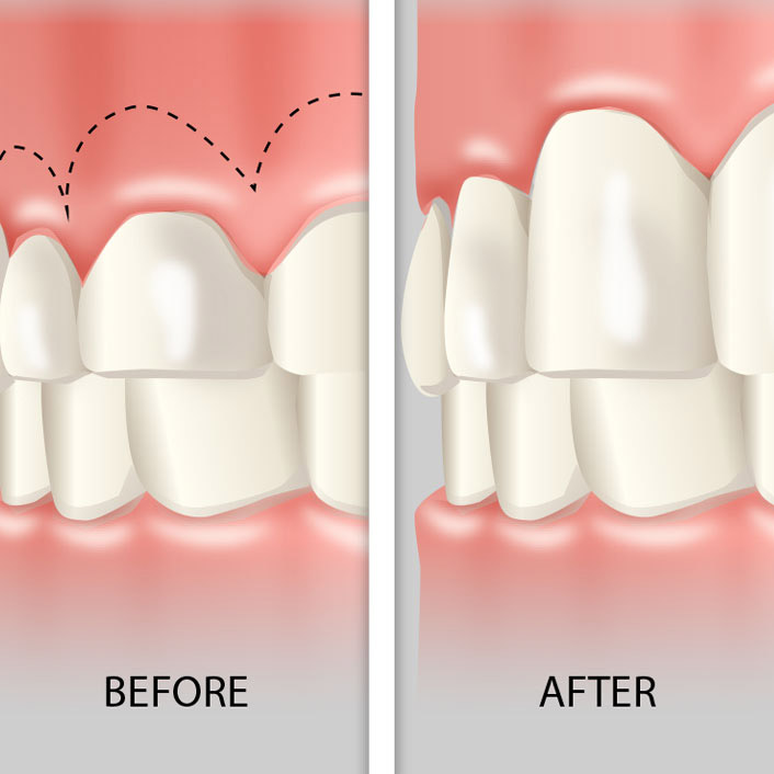 Gummy Smile Corrective Surgery - Dental Services