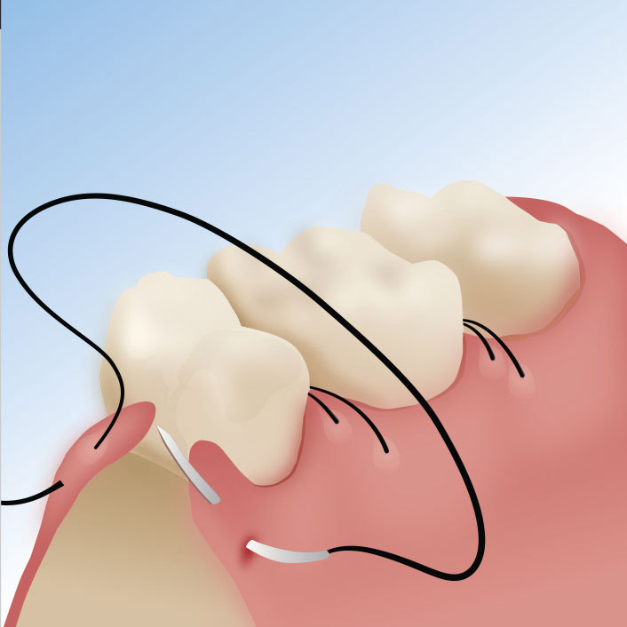 Periodontal Flap Surgery

 - Dental Services