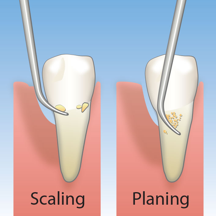 Scaling and Root Planing - Dental Services