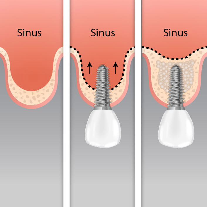 Sinus Elevation Surgery
 - Dental Services